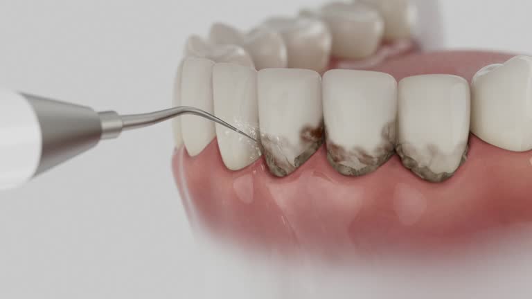 Trusted Tooth Extraction service in North Olmsted, OH - Dentist Open Now
